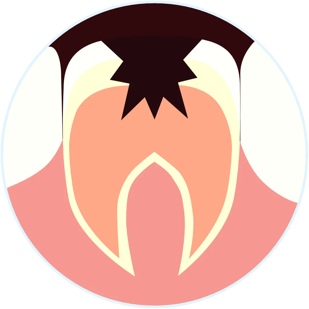 むし歯が歯髄まで進行した歯のイラスト